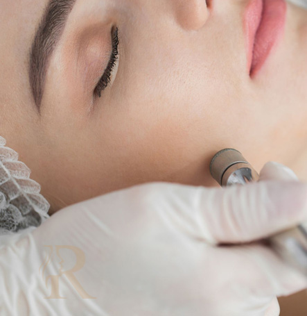 Microdermabrasion